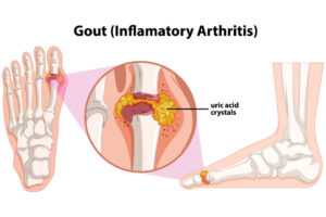 Gout Image